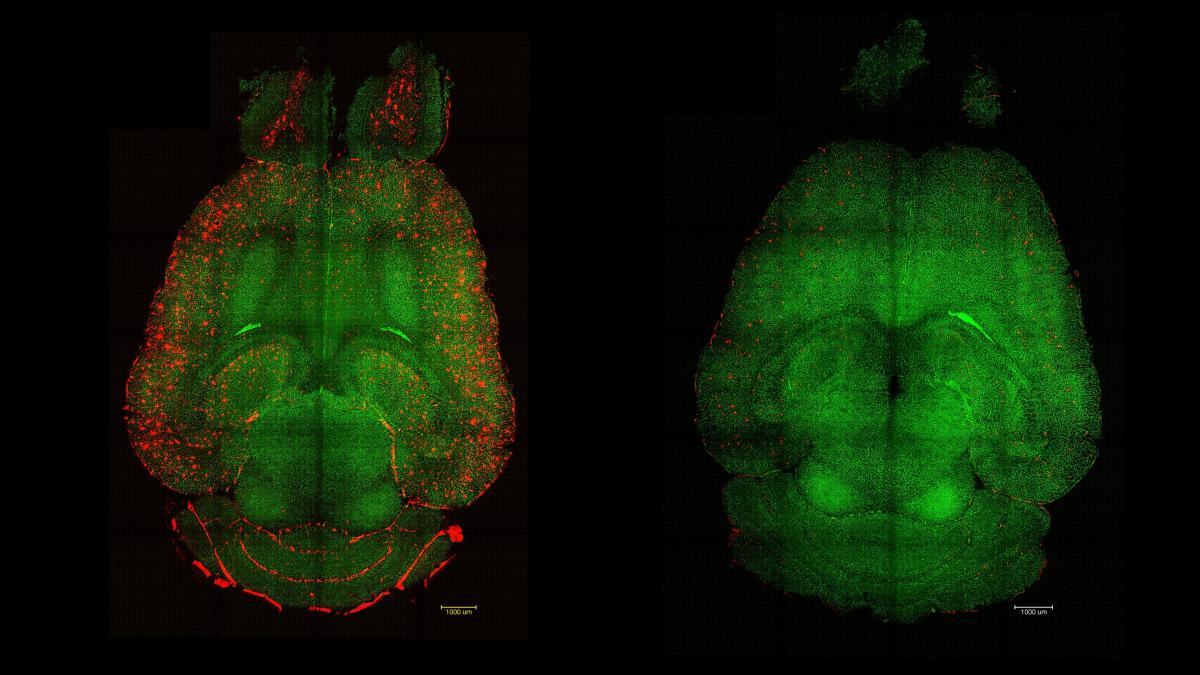 Nanopartículas y alzhéimer
