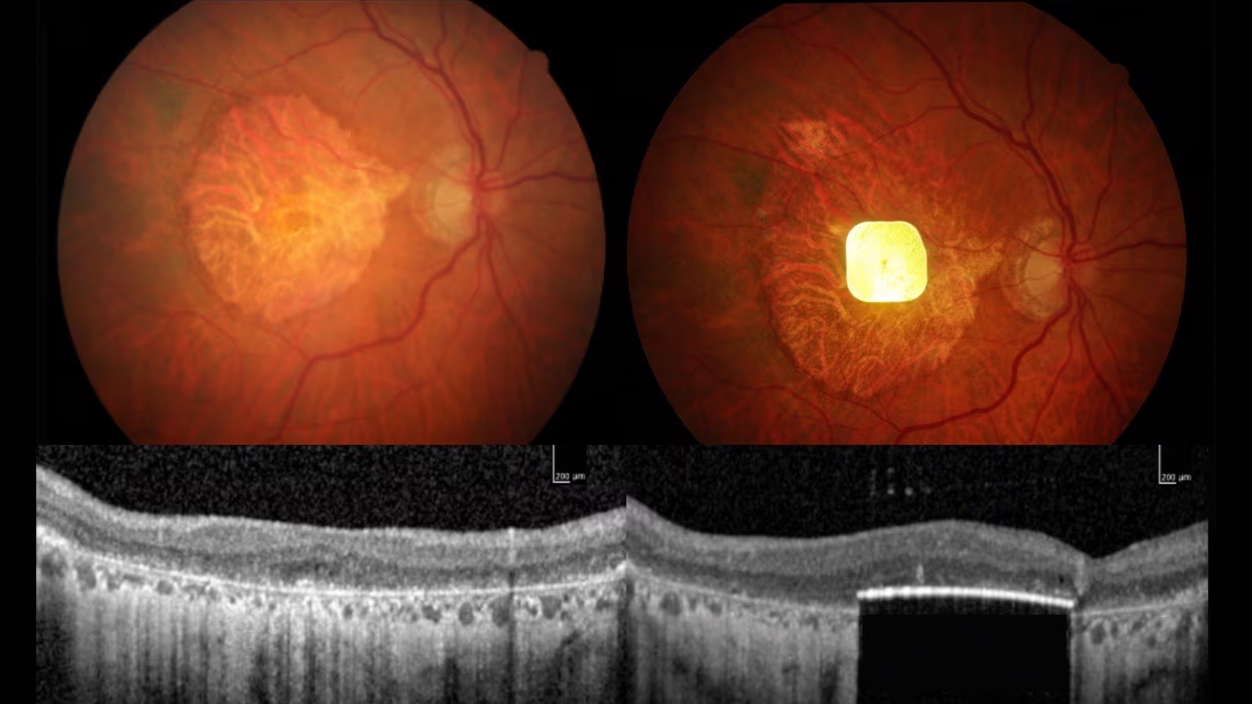 implante de retina inalámbrico
